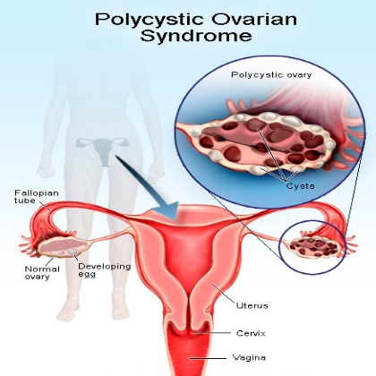 Ovarian Problem